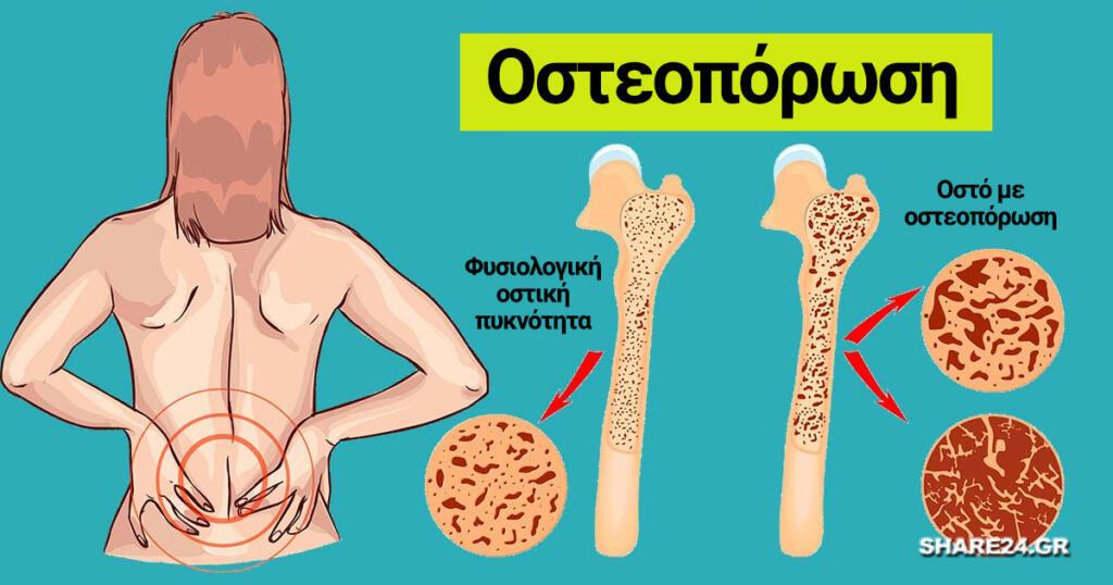 13-tropi-gia-na-stamatisete-tin-osteoporosi-ke-na-enischysete-ta-osta-sas